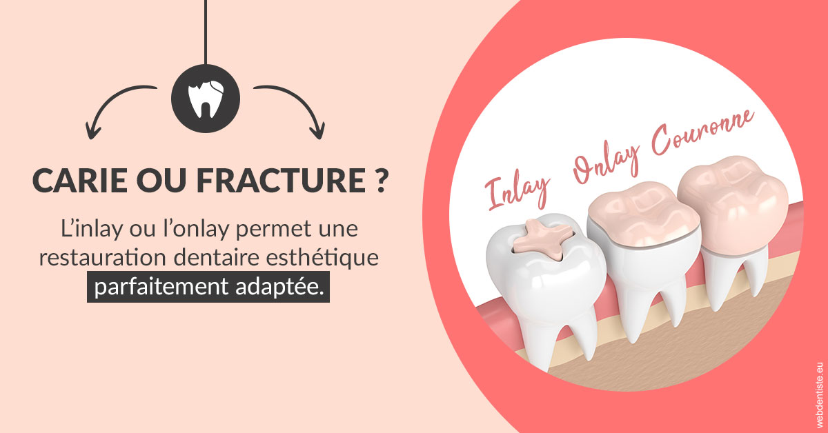 https://dr-laure-roquette.chirurgiens-dentistes.fr/T2 2023 - Carie ou fracture 2