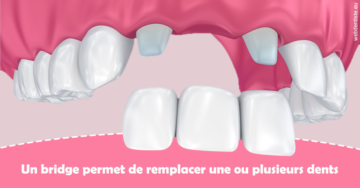 https://dr-laure-roquette.chirurgiens-dentistes.fr/Bridge remplacer dents 2