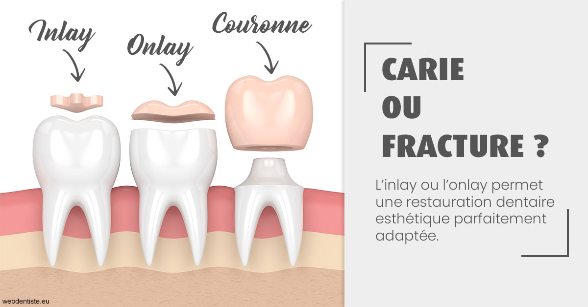https://dr-laure-roquette.chirurgiens-dentistes.fr/T2 2023 - Carie ou fracture 1