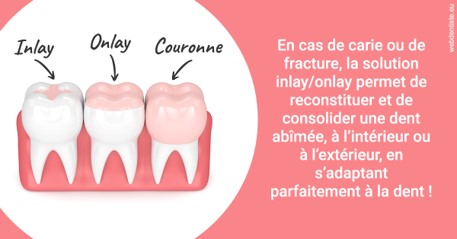 https://dr-laure-roquette.chirurgiens-dentistes.fr/L'INLAY ou l'ONLAY 2