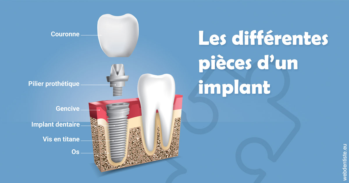 https://dr-laure-roquette.chirurgiens-dentistes.fr/Les différentes pièces d’un implant 1